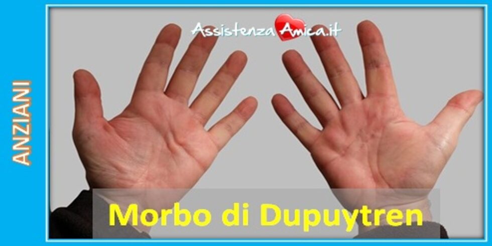 Deformit Della Mano Il Morbo Di Dupuytren Assistenza Amica